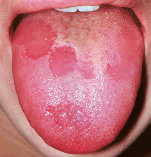 Have you ever heard of geographic tongue?