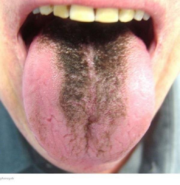 Have a brown or black hairy tongue?