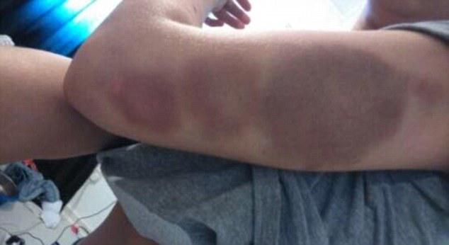 These are just some of the bruises Miss Skillen developed after the brutal four-hour assault
