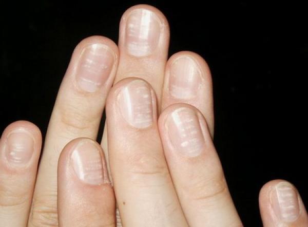 Τι προκαλεί τα λευκά σημάδια στα νύχια;