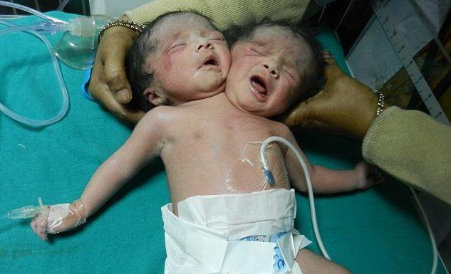 ΙΝΔΙΑ: -Γεννήθηκε μωρό με δύο κεφάλια (σοκαριστικό βίντεο)