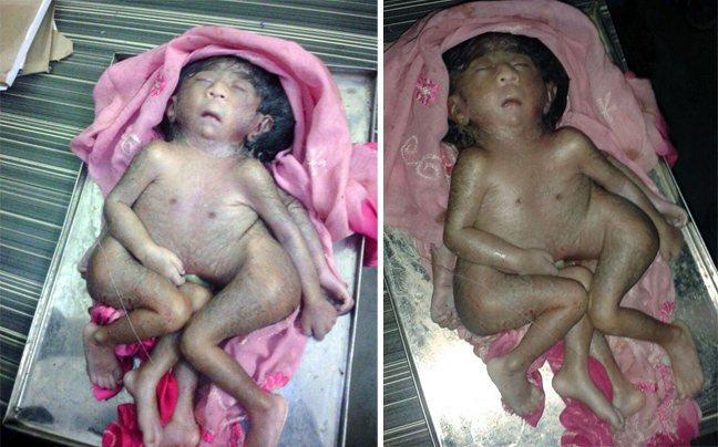 Μωρό με 8 άκρα λατρεύεται σαν θεός στην Ινδία – Δείτε τις φωτογραφίες