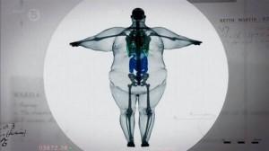 Έτσι είναι η ακτινογραφία ενός υπέρβαρου ανθρώπου. παρατηρείστε πως καταπονούνται τα κόκαλα του