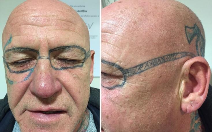 Ξύπνησε από άγριο μεθύσι και του είχαν κάνει τατουάζ «γυαλιά» στο πρόσωπο!