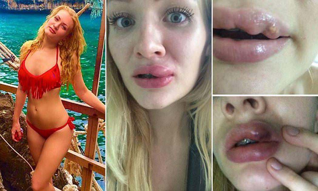 Η πανέμορφη 24χρονη δασκάλα που ήθελε σαρκώδη χείλη αλλά η πλαστική… δεν πήγε καθόλου καλά
