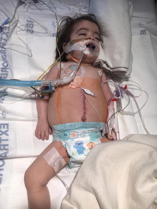 When Madeline was born she was hooked to a ventilator to allow her lung tissues to develop. 