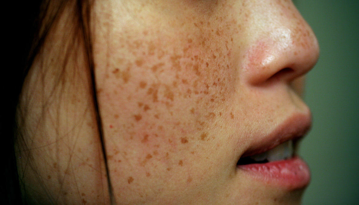 Women in the past attempted to rid of their freckles using ridiculous ingredients such as fresh urine or crocodile fat. 