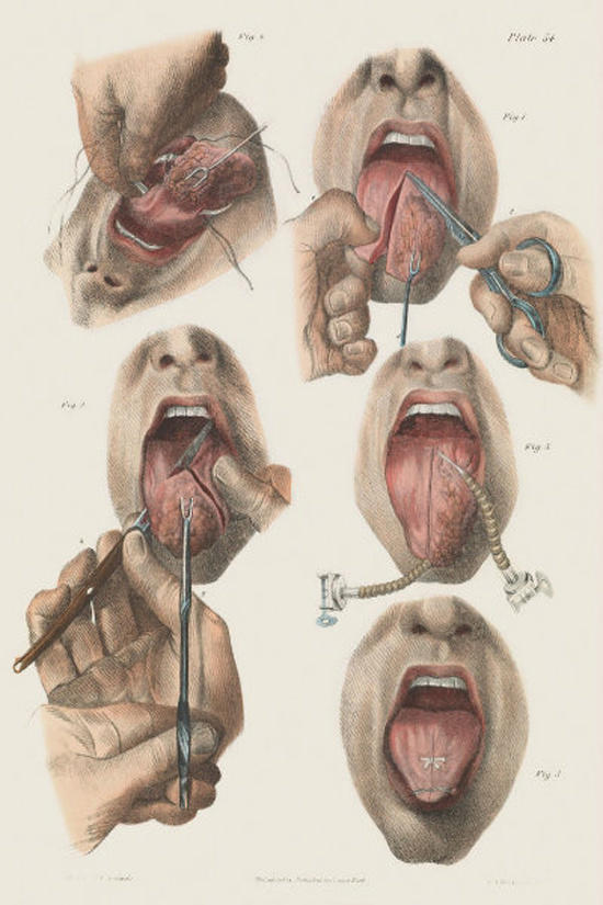 Patients suffering from cancer in the tongue had to have parts or all of it removed. 