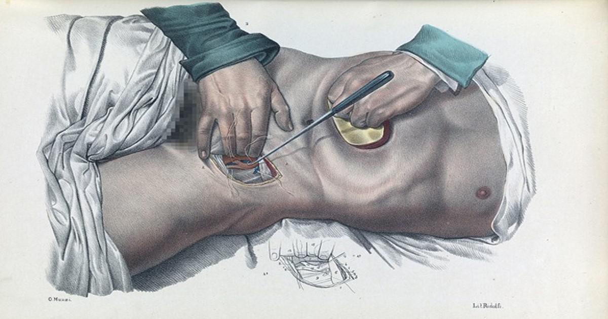 Πώς γίνονταν οι χειρουργικές επεμβάσεις το 1840; Συγκλονιστικές εικόνες από χειρουργεία χωρίς αναισθητικό.