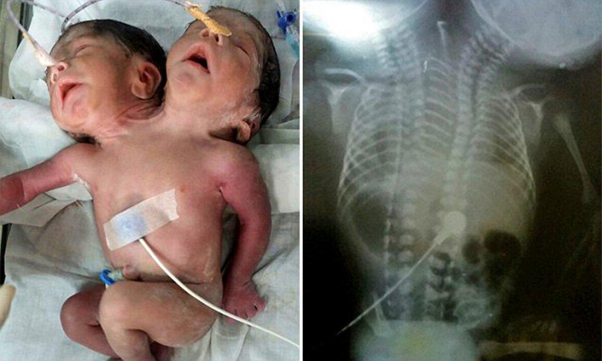 ΣΥΓΚΛΟΝΙΣΤΙΚΟ: Η αληθινή ιστορία του μωρού που γεννήθηκε με 2 κεφάλια. Σοκαρισμένοι οι γιατροί παγκοσμίως!