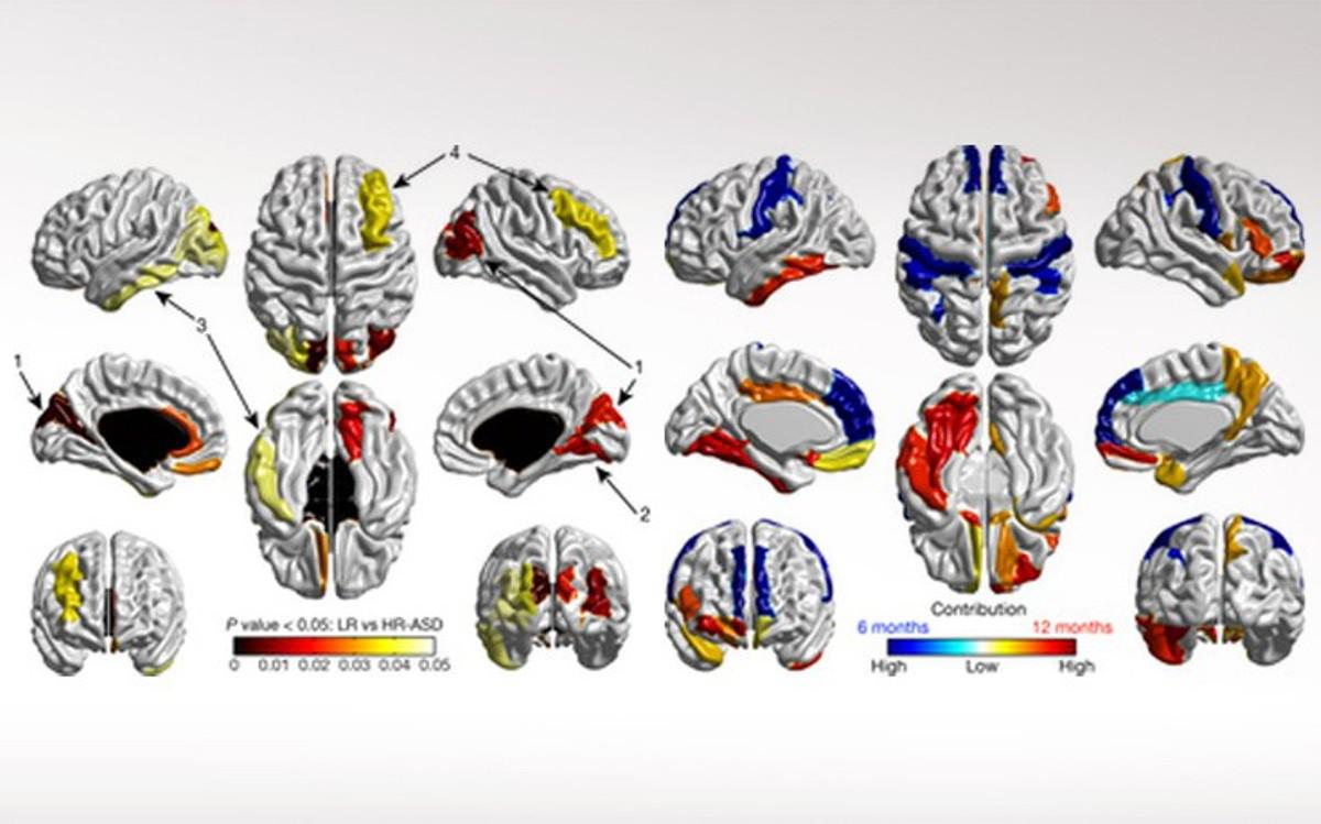 Νέος αλγόριθμος διαβάζει τον εγκέφαλο των βρεφών και προβλέπει τον αυτισμό