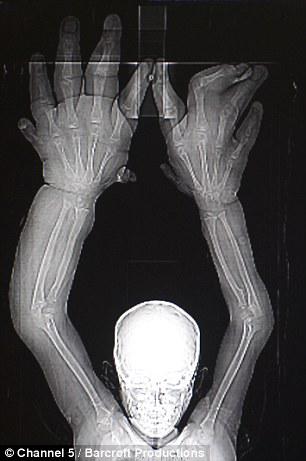 This x-ray shows the extent that local gigantism has affected the growth of Kaleem