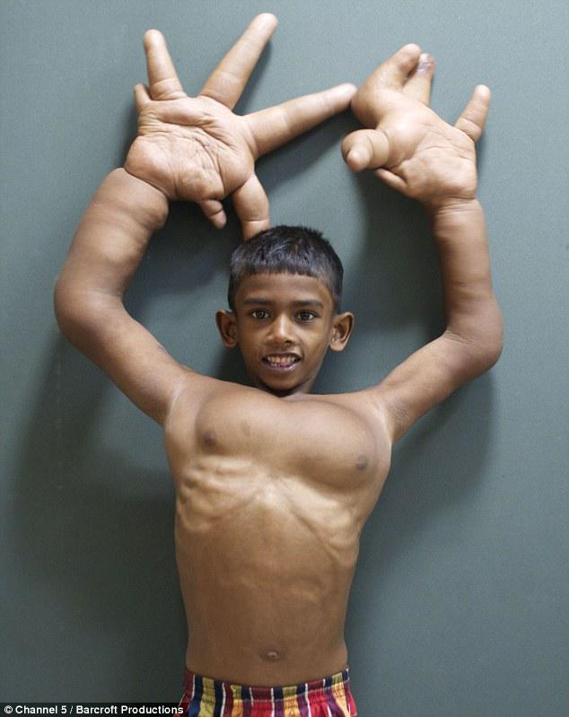 Getting help: Kaleem takes a playful pose whilst being examined at Ganga Hospital in Coimbatore, where doctors will attempt to scale back the size of his hands and improve his standard of living