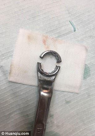 The man had had his penis stuck in the ring spanner