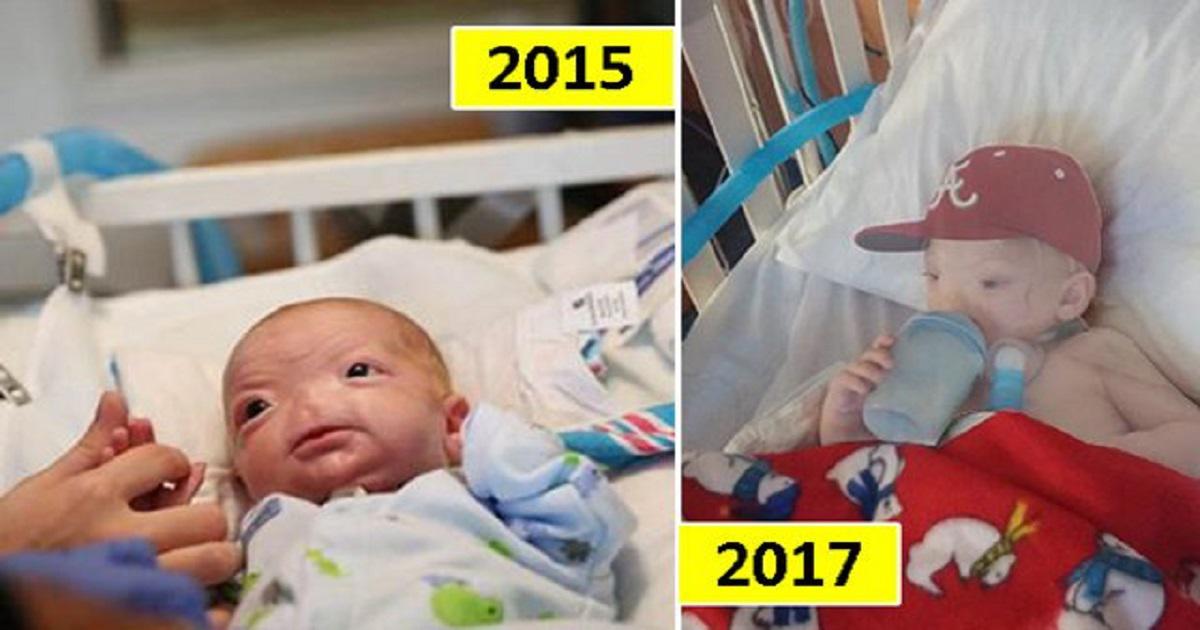 Μωρό που γεννήθηκε χωρίς μύτη βρίσκει τραγικό θάνατο στην ηλικία των 2 και βυθίζει στη θλίψη τους δικούς του