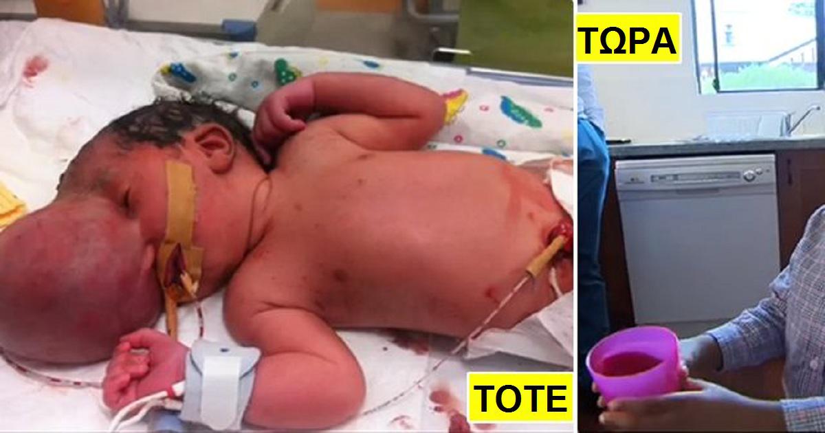 Οι γιατροί της είπαν να ρίξει το μωρό της που θα γεννιόταν με τον εγκέφαλο έξω από το κρανίο. Εκείνη όμως δεν τους άκουσε και έκανε το σωστό
