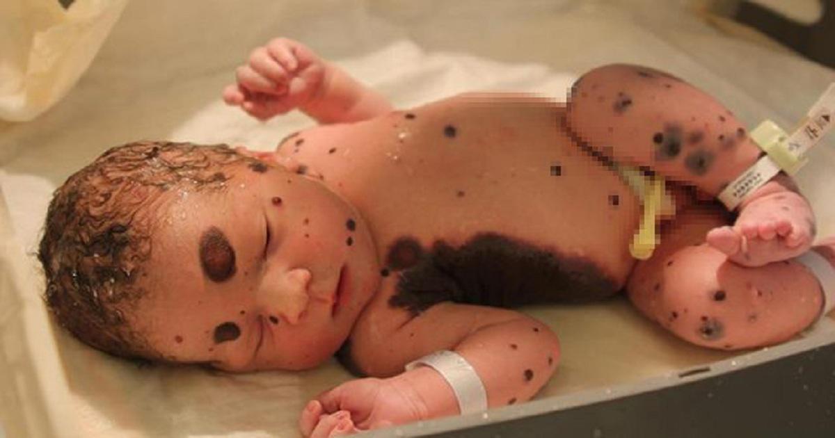 Μητέρα πανικοβλήθηκε όταν είδε το 80% του σώματος του μωρού της καλυμμένο με κηλίδες αίματος. Αλλά υπήρχε και κάτι ακόμα χειρότερο