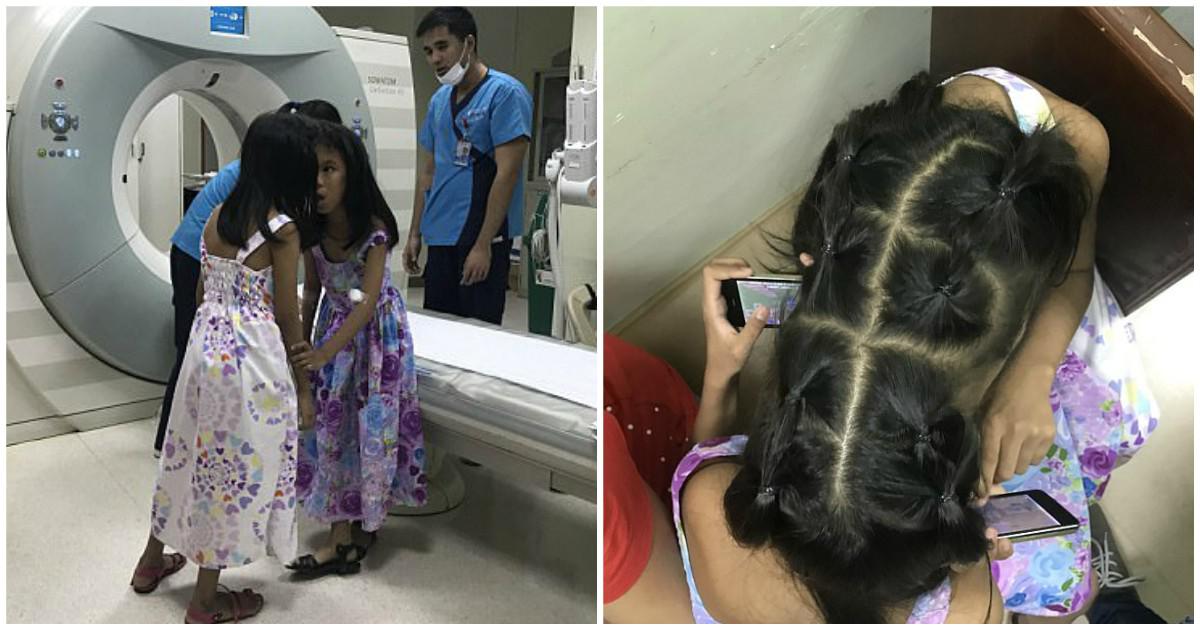 Σιαμαία κοριτσάκια 10 ετών ενωμένα στο κεφάλι θα υποβληθούν σε επέμβαση διαχωρισμού με ρίσκο να πεθάνουν την ώρα του χειρουργείου