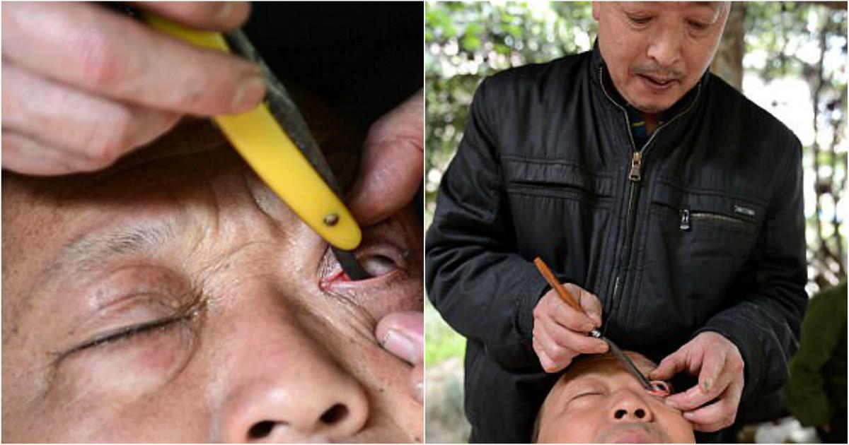 Μπαρμπέρης ξυρίζει το εσωτερικό των ματιών από τους πελάτες του για να βελτιώσει την όρασή τους