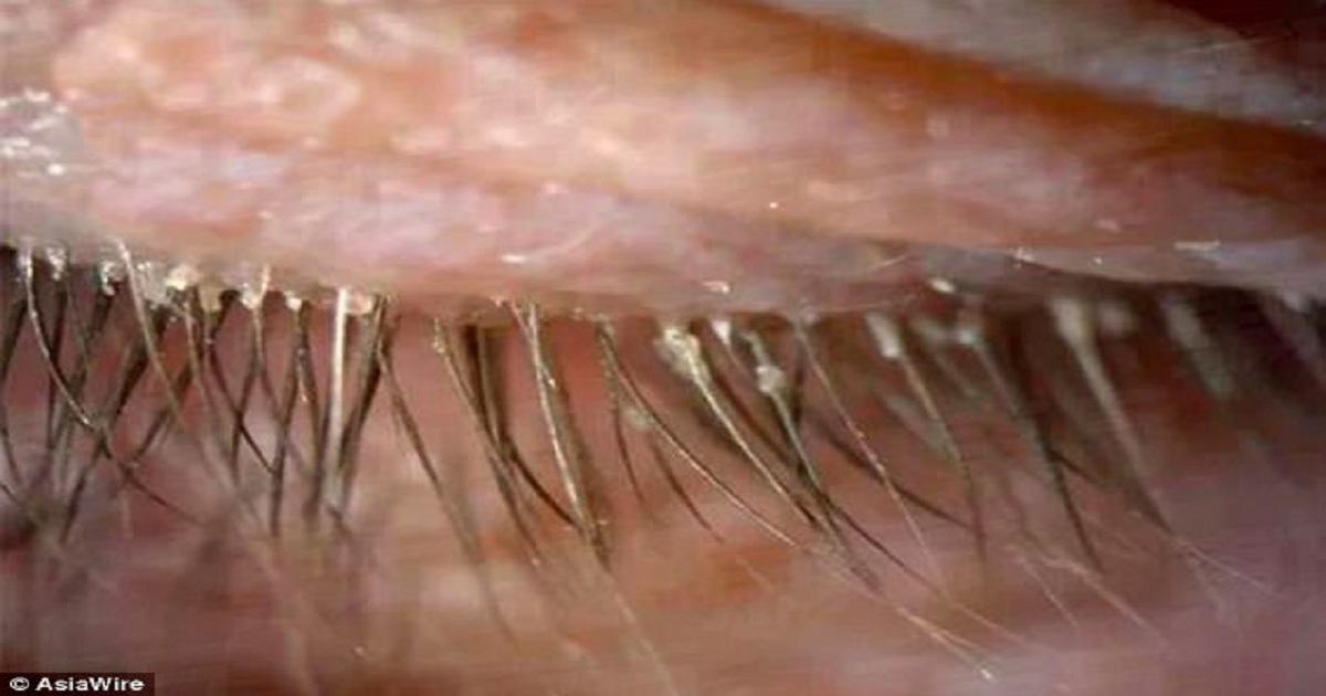 Γυναίκα ανακάλυψε πως η φαγούρα στα μάτια της προκλήθηκε από 100 παράσιτα που ζούσαν στις βλεφαρίδες της