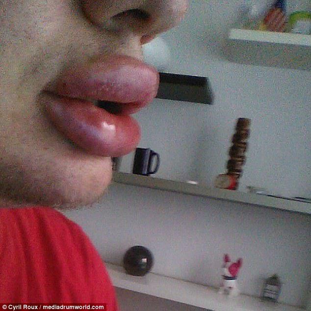 The waiter has had 16 lip fillers over the past 18 months in order to get his extreme pout 