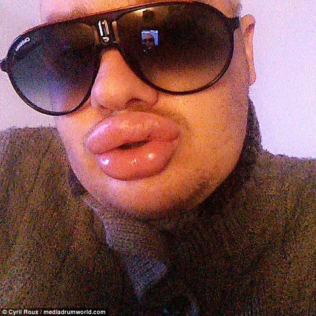 Cyril has his lips injected with filler once every two months, and has spent over £3,500 (4,000 Euros) on his pout alone 