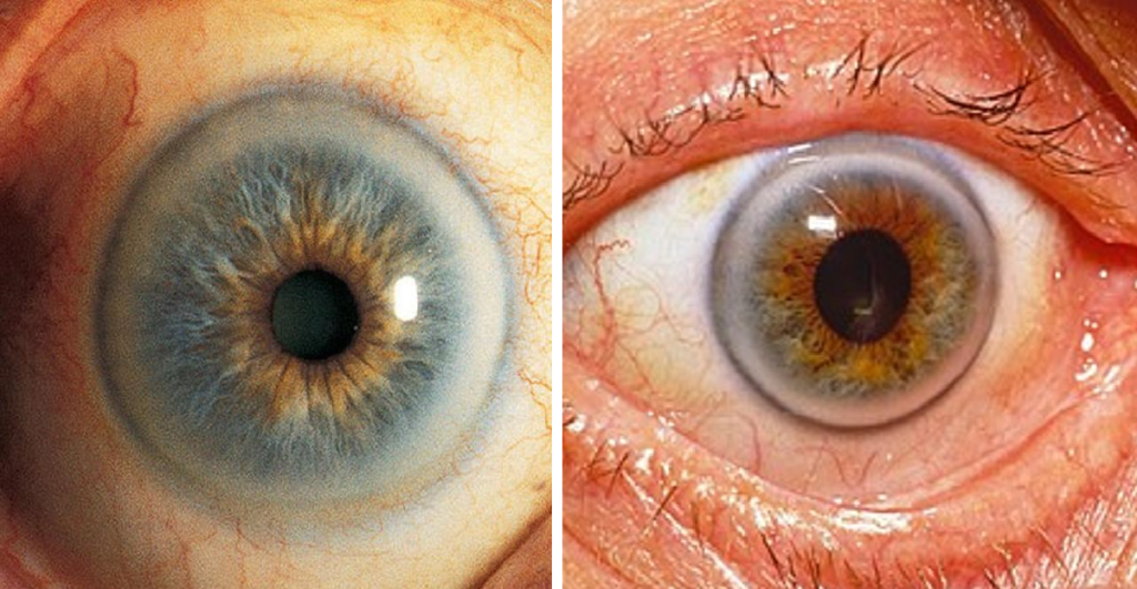 Υψηλή χοληστερίνη: Το σημάδι στα μάτια που δείχνει ανεβασμένη χοληστερόλη