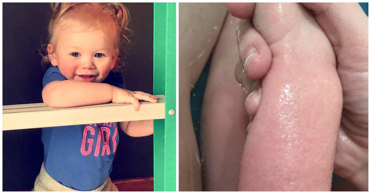 Μωρό 18 μηνών είναι αλλεργικό στο νερό και βγάζει φουσκάλες κάθε φορά που κλαίει ή ιδρώνει