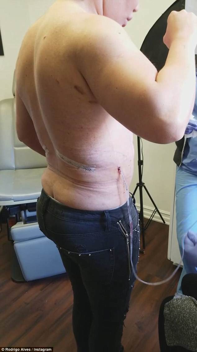 Harsh: Rodrigo had four ribs removed at the start of the year, but the procedure has left him with scars (pictured)