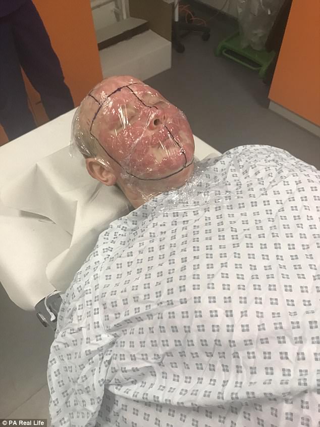 Although, doctors warn that she is too unwell to go through with the procedure, currently - even though a donor has been found (pictured during face radiotherapy)