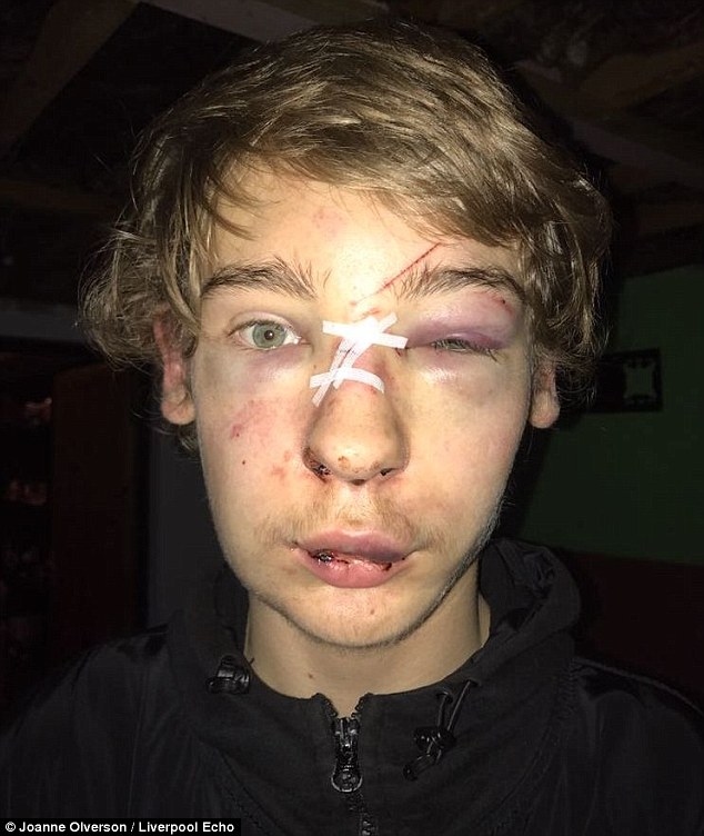 Cole, now 16, still struggles with breathing and has anxiety and depression. HeÂ suffered a fractured nasal bone, a cut to his nose, plus bruising to his forehead, left cheek and jaw