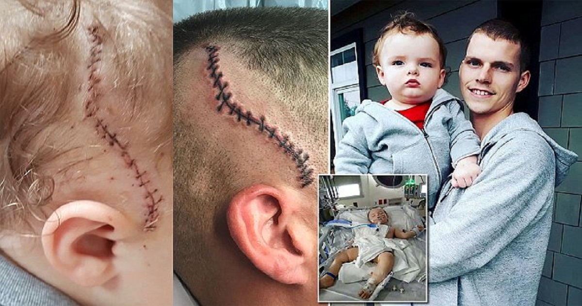 Μπαμπάς έκανε τατουάζ- ουλή στο κρανίο του για να έχει το ίδιο σημάδι με τον 1 έτους γιο του που έκανε εγχείρηση στο κεφάλι