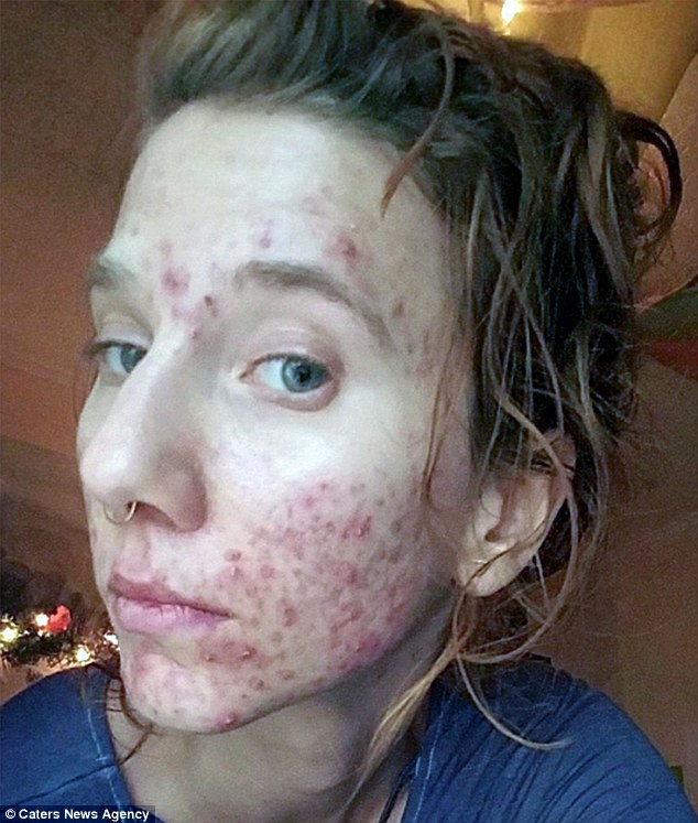 Julia Sillaman, 26, said she was 'hesitant' to visit a dermatologist after developing severe acne, and instead tried drinking her own urine and rubbing it on her face