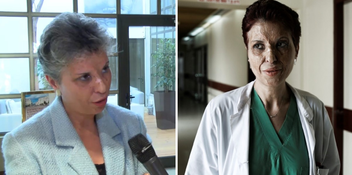 Καλλιόπη Αθανασιάδη: Επιβίωσε από φριχτό ατύχημα και έγινε κορυφαία χειρουργός
