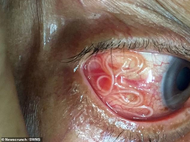 The unnamed patient, from India, complained of both pain and itching in his eyes and decided to seek medical help (pictured: the worm in the man's eye)
