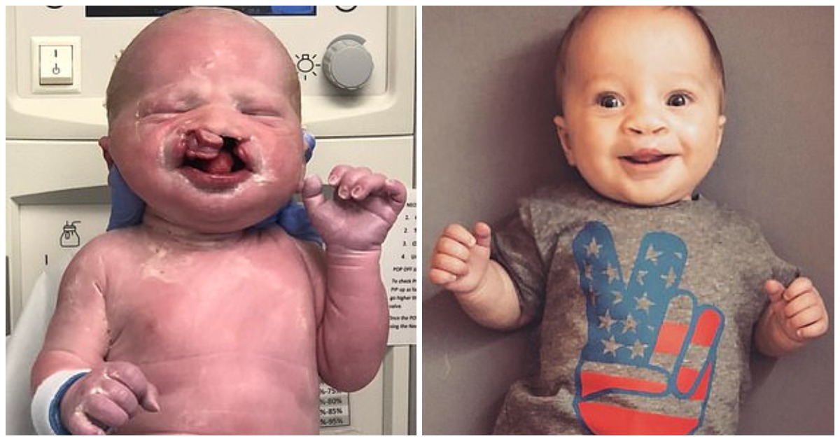 Μωρό χωρίς χείλος και ουρανίσκο χαμογελάει για 1η φορά στους γονείς του μετά το χειρουργείο που του έφτιαξαν νέο στόμα