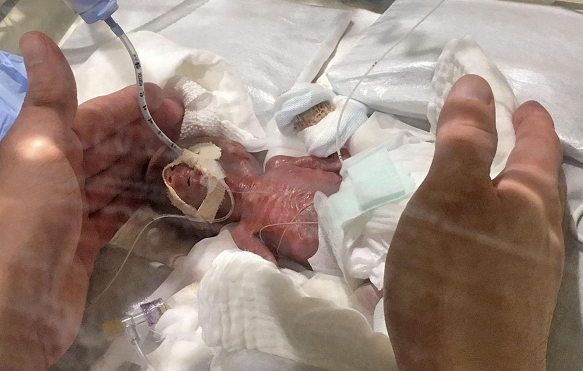 Τα κατάφερε! Το μικρότερο νεογέννητο αγόρι στον κόσμο γεννήθηκε μόλις 268 γραμμάρια και θα ζήσει τη ζωή του