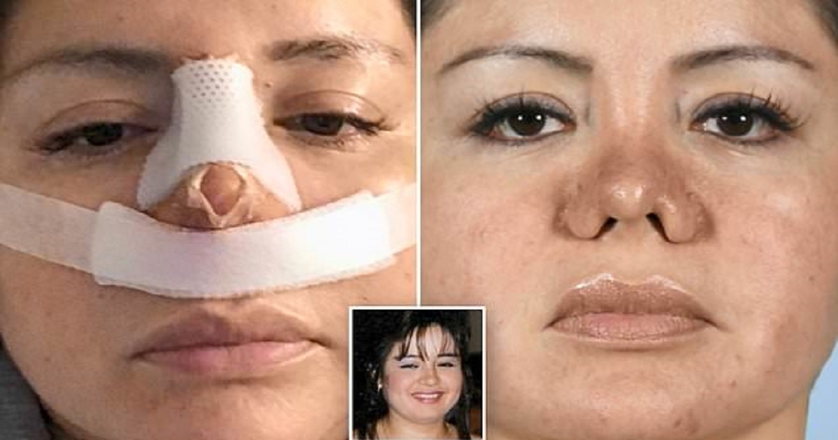 Γυναίκα πήγε σε πλαστικό να κάνει λιποαναρρόφηση και της έβαλε κατά λάθος καινούργια μύτη