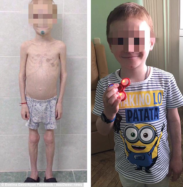 Valery was starved and drugged by the foster mother so she could claim his sick benefits (pictured left when he was removed from her care in May 2017, and again at a later date)