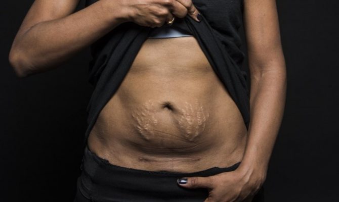 13 δυνατές φωτογραφίες που δείχνουν ότι οι μαμάδες που γεννούν με καισαρική είναι αληθινές μαχήτριες