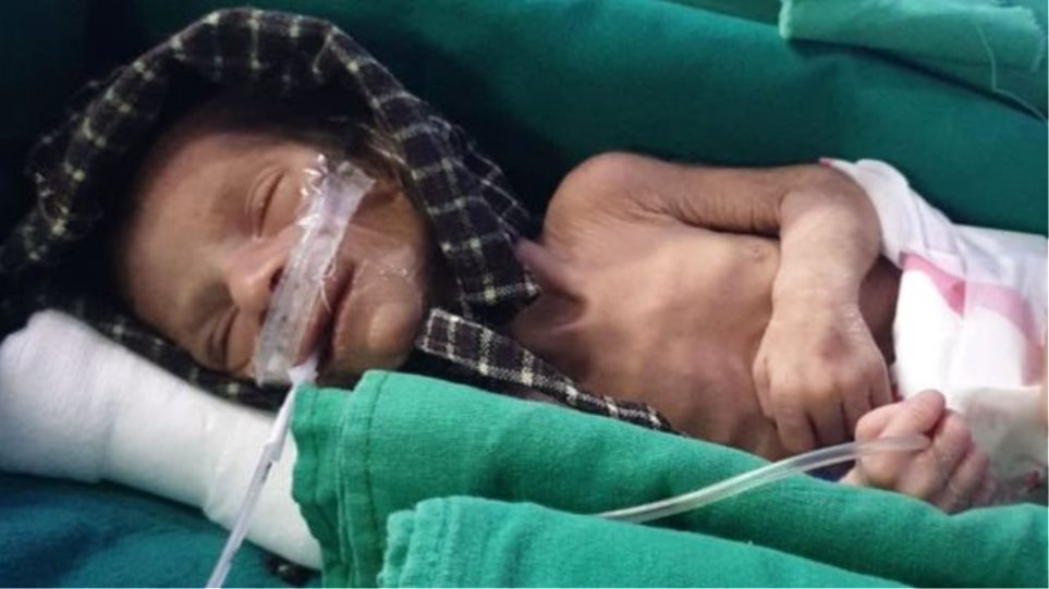 Ινδία: Το νεογέννητο κοριτσάκι που είχε θαφτεί ζωντανό κέρδισε τη μάχη για τη ζωή