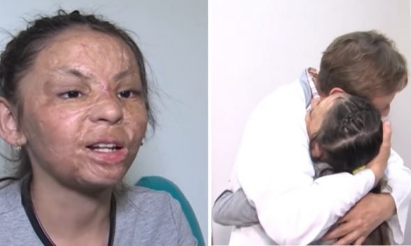 Πλαστικός χειρούργος βοήθησε κοριτσάκι με σοβαρά εγκαύματα να αποκτήσει καινούριο πρόσωπο
