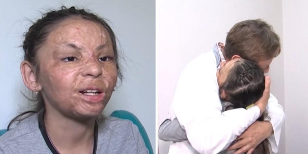 Πλαστικός χειρούργος βοήθησε κοριτσάκι με σοβαρά εγκαύματα να αποκτήσει καινούριο πρόσωπο
