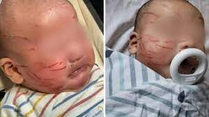 Μητέρα παρέλαβε το μωρό της από τον παιδικό σταθμό με 20 γρατζουνιές στο πρόσωπό του: «Πρόκειται για κακοποίηση παιδιού»